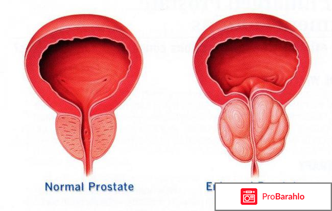 Лечение хронического простатита народными средствами самые эффективные 