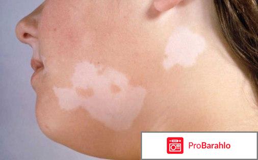 Пятна на теле отзывы владельцев