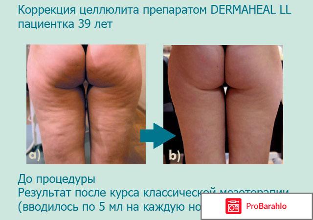 Dermaheal ll липолитик обман