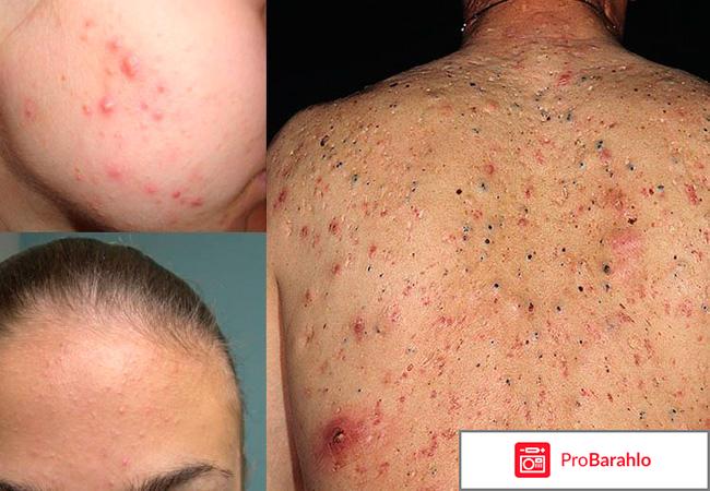 Андрогенное акне 