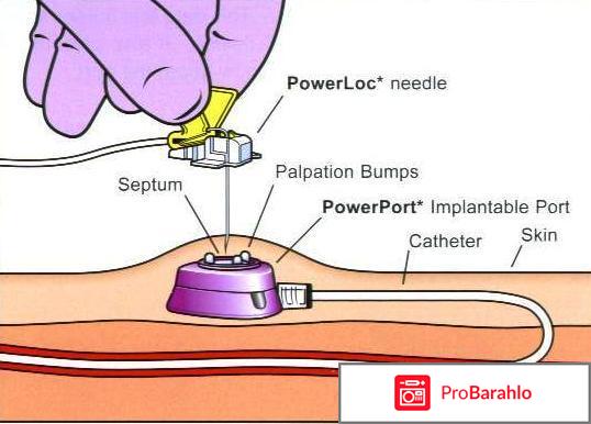 Имплантируемые порт-системы port-a Cath обман