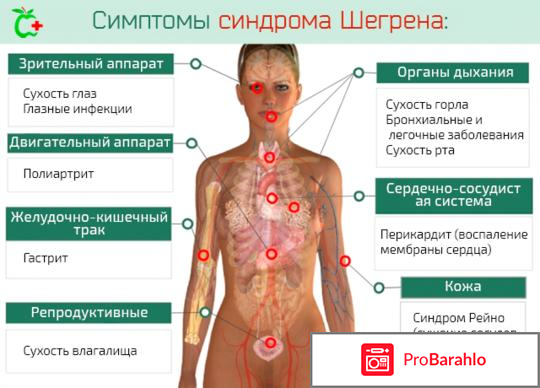 Болезнь Шегрена симптомы лечение 