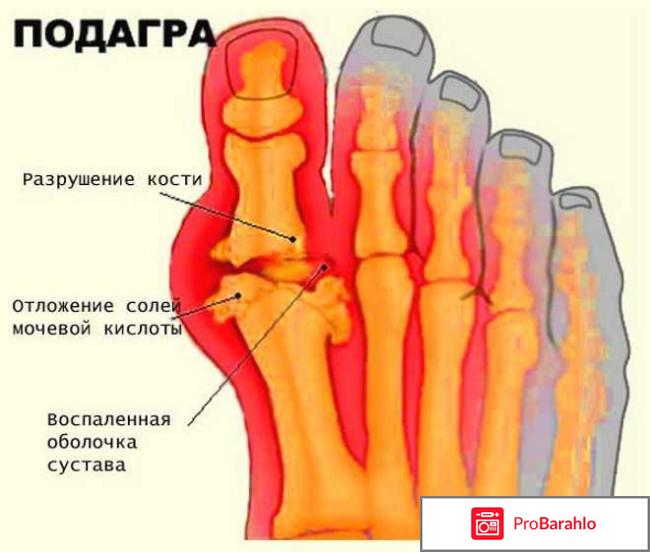 Как вывести мочевую кислоту 