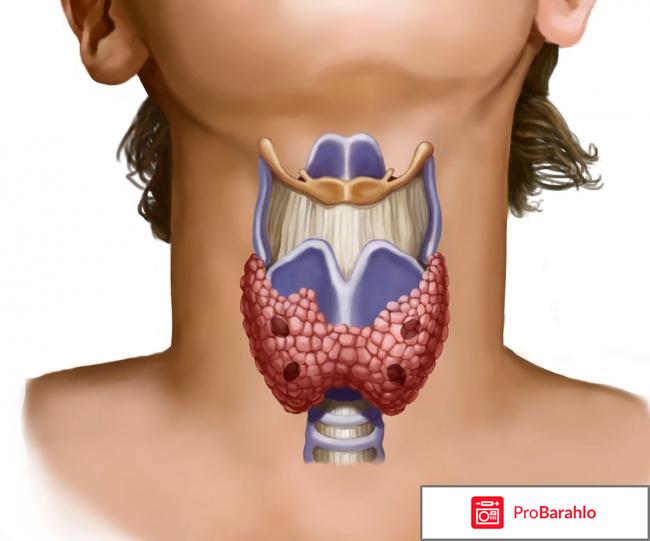 Гипотиреоз при нормальных гормонах 