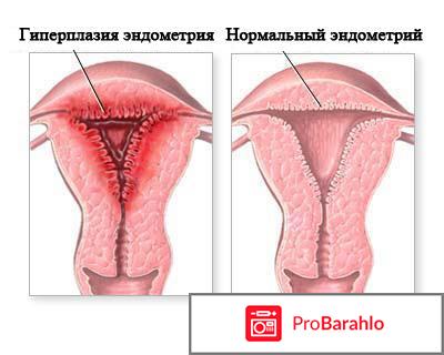 Народные средства лечения эндометриоза у женщин отзывы 