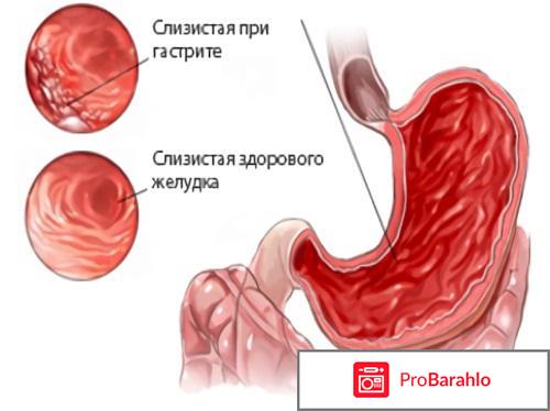 Поверхностный гастрит что это такое как лечить 