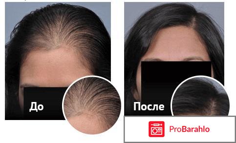 Капсулы для роста волос отзывы 