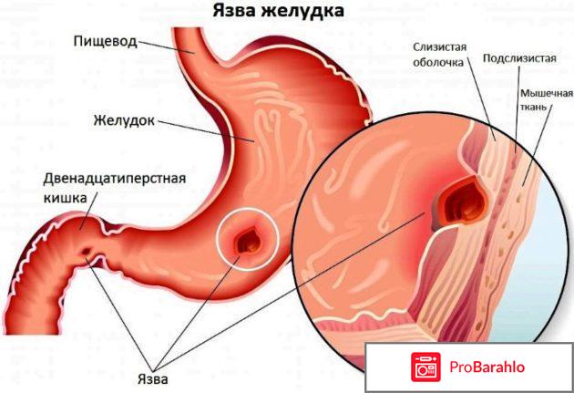 Операция язва желудка послеоперационный период 