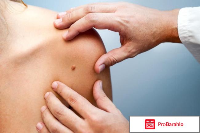 Прививка от вируса папилломы человека отзывы отрицательные отзывы