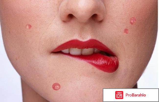 Как быстро избавиться от прыщей 