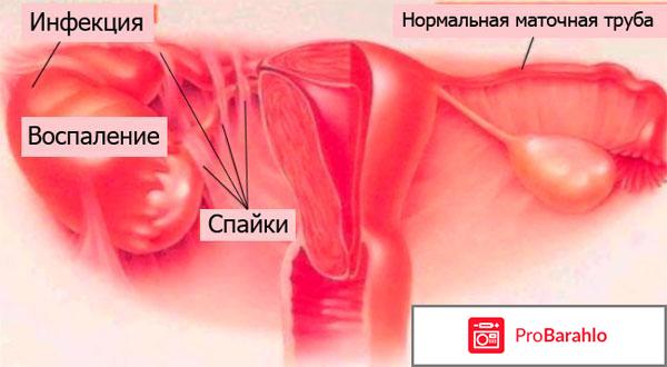 Спайки малого таза симптомы 