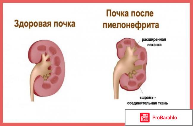 Пиелонефрит симптомы у женщин лечение отзывы обман