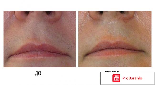 Лазерная депиляция обман