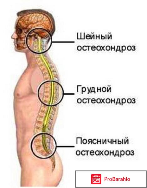 Лечение остеохондроза шейного отдела 