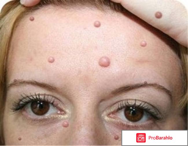 Дегтярное мыло от папиллом обман