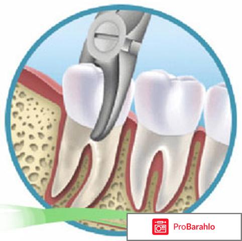 Удаление коренного зуба 
