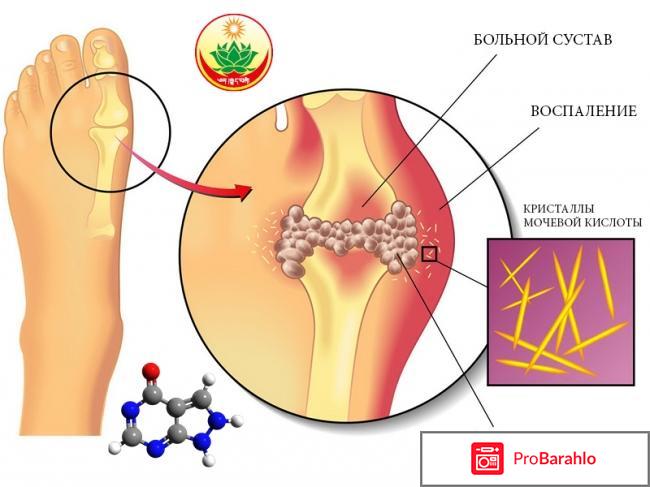 Мочевая кислота в организме отрицательные отзывы