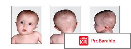 Кривошея у взрослых лечение отрицательные отзывы