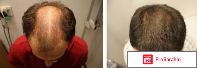 Эксидерм активатор роста волос отзывы отрицательные отзывы