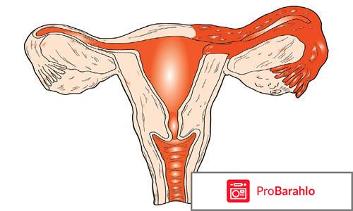 Воспаление придатков матки: симптомы и особенности отрицательные отзывы