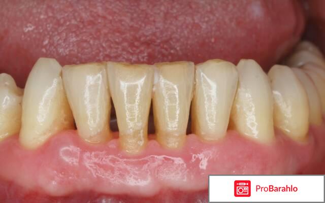 Пародонтоз 