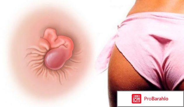 Чем лечить геморрой у женщин отзывы форум 