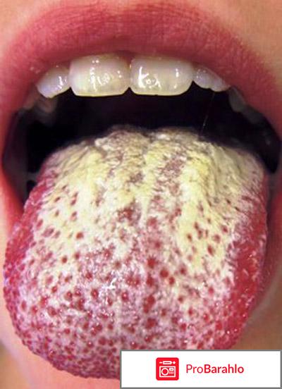 От чего бывает молочница 