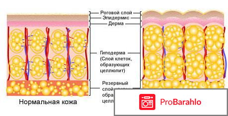 Как убрать целлюлит на ногах 