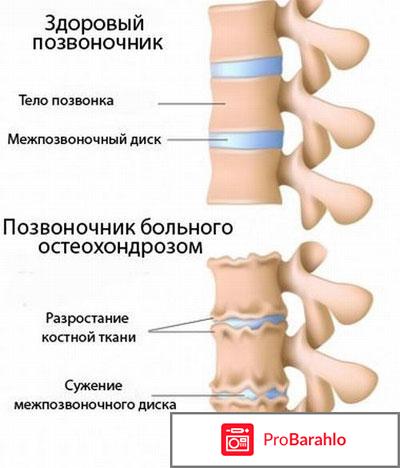 Лечение шейного остеохондроза народными средствами лучшими обман