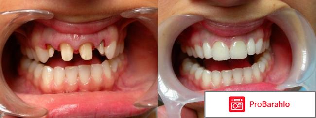 Коронки металлокерамика отрицательные отзывы