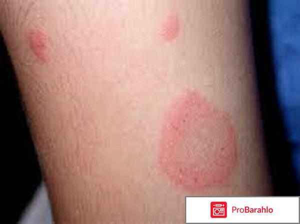 Розовый лишай у детей: симптомы и лечение обман