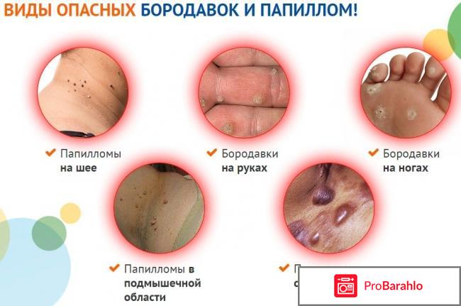 Клареол гель лекарство от папиллом отрицательные отзывы