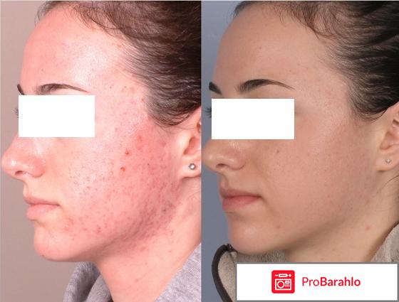 Левомеколь применение 