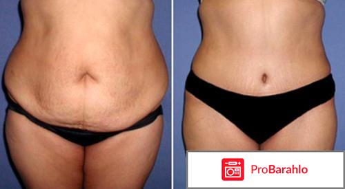 Пластика живота фото 