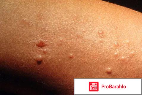 Крем против прыщей обман