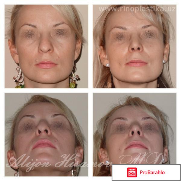 Риносептопластика это обман