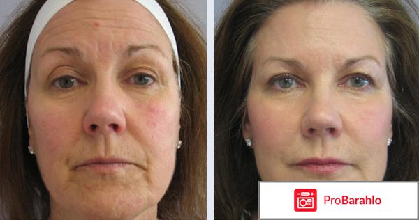 Плазмолифтинг отзывы 