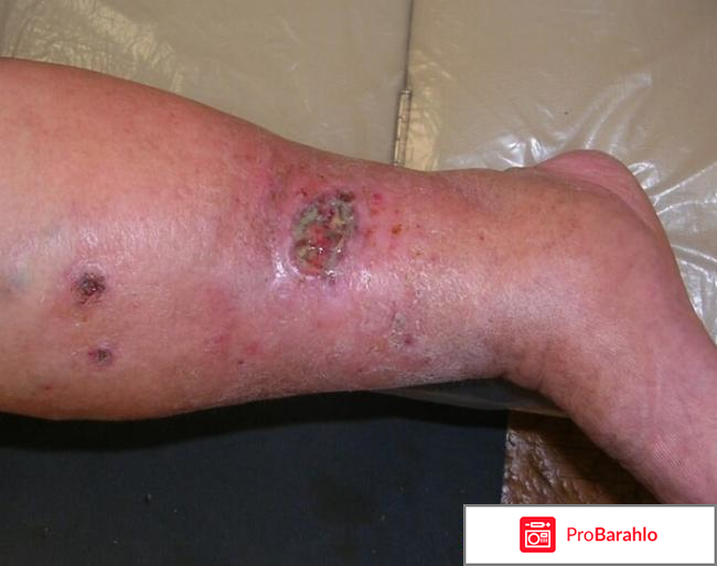 Метилурацил мазь цена отзывы 