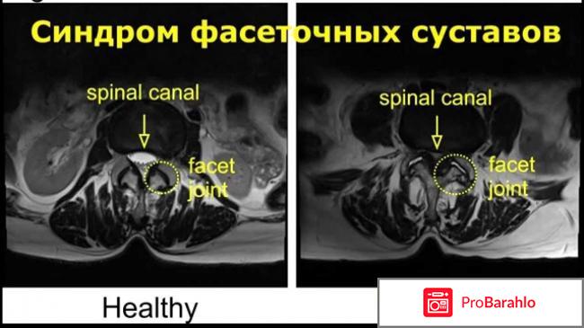 Фасеточный синдром 