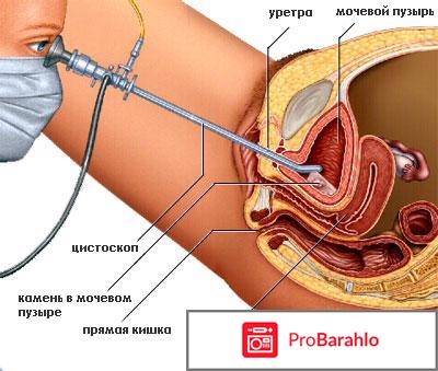 Цистоскопия отзывы женщин 