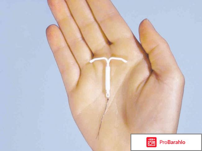 Мирена отзывы врачей отрицательные отзывы