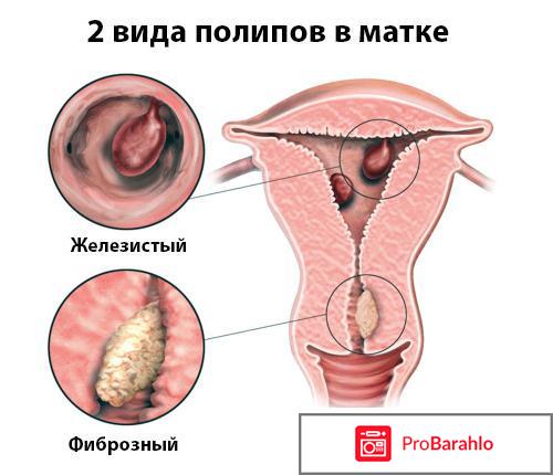 Полипэктомия матки 