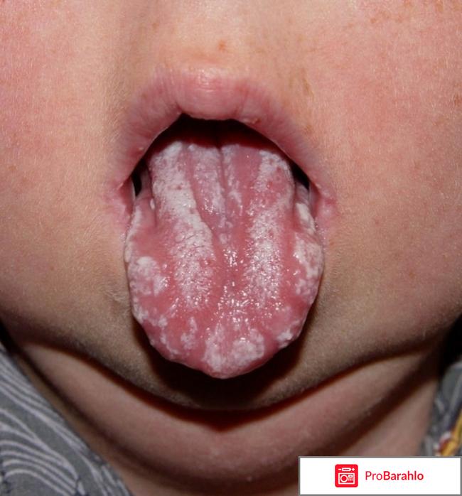 Почему у ребенка во рту и на языке белый налет: причины обман