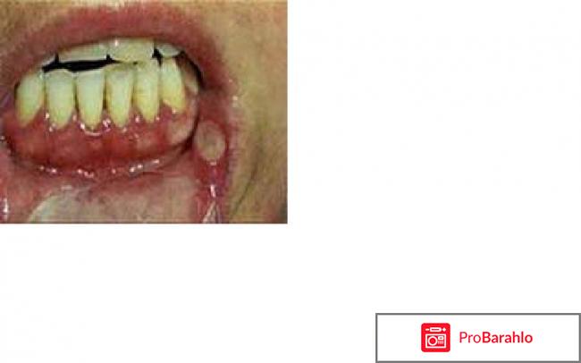 Стоматит венсана 