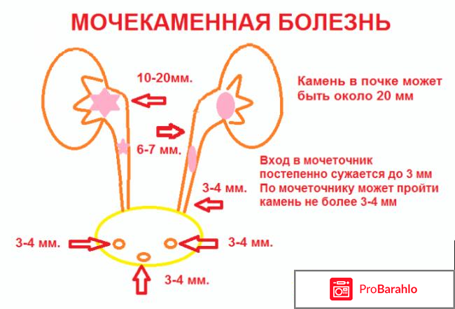 Цистон отзывы при мочекаменной болезни у женщин 