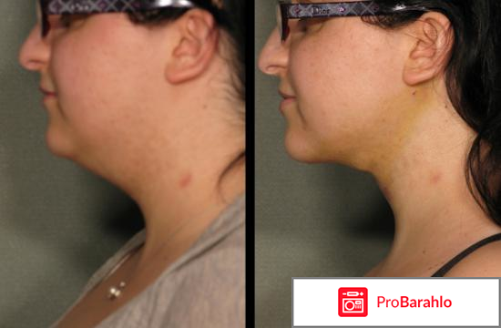 Липолитики отзывы фото до и после лицо обман