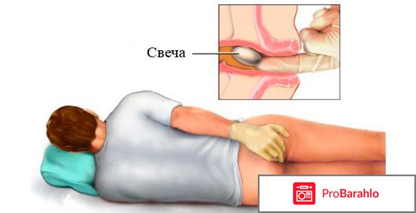 Бисакодил свечи отрицательные отзывы