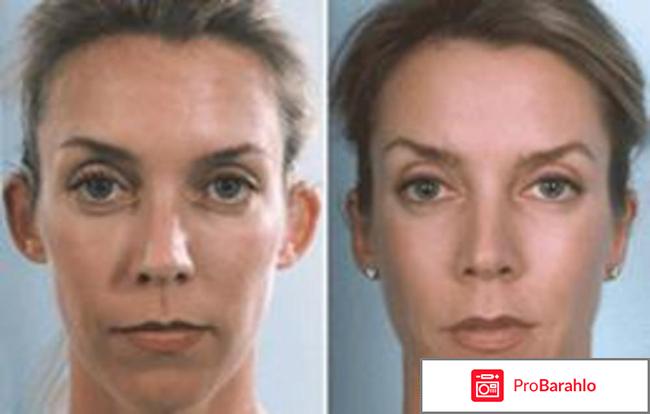 Пластика ушей 