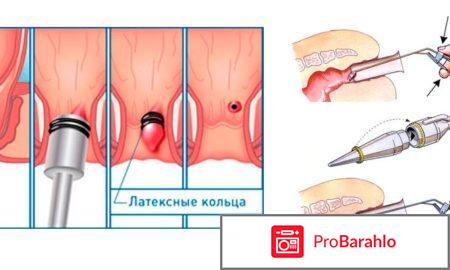 Удаление геморроидальных узлов отзывы владельцев