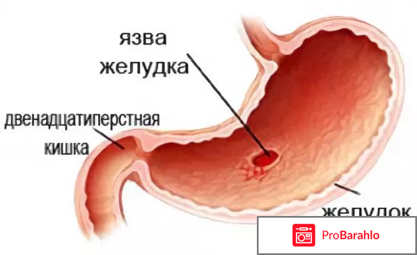 Противоязвенные препараты для желудка 